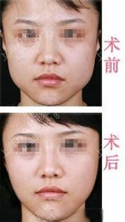 一般祛颊脂垫有没有后遗症